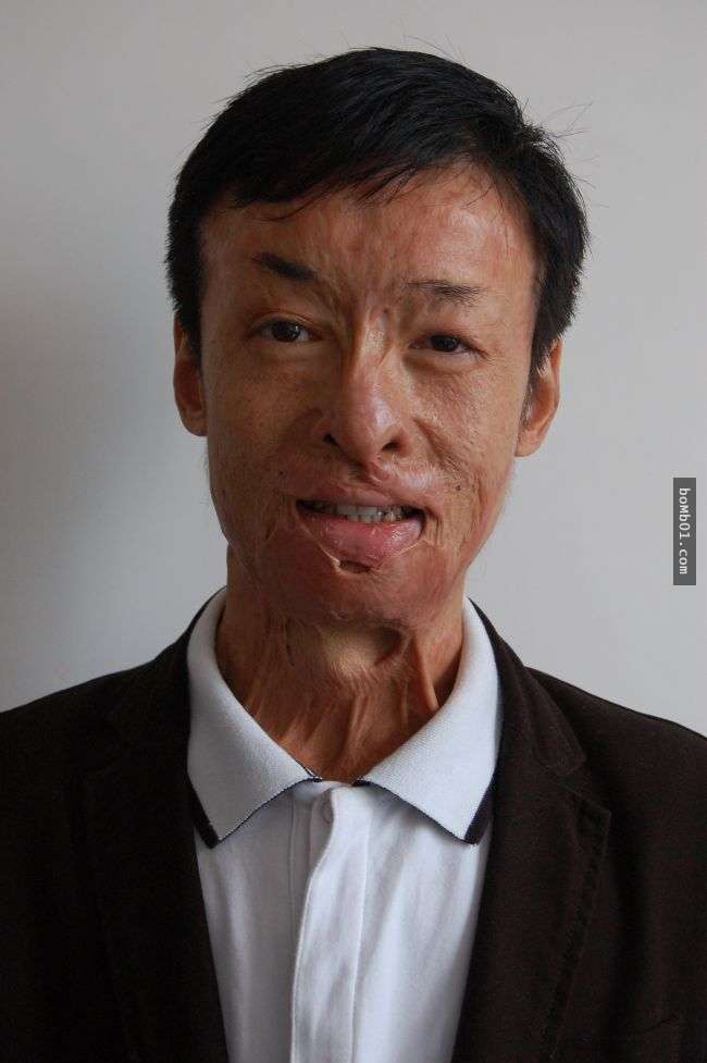 他在21岁时因闯入火场救人而毁容后,这个女生的出现