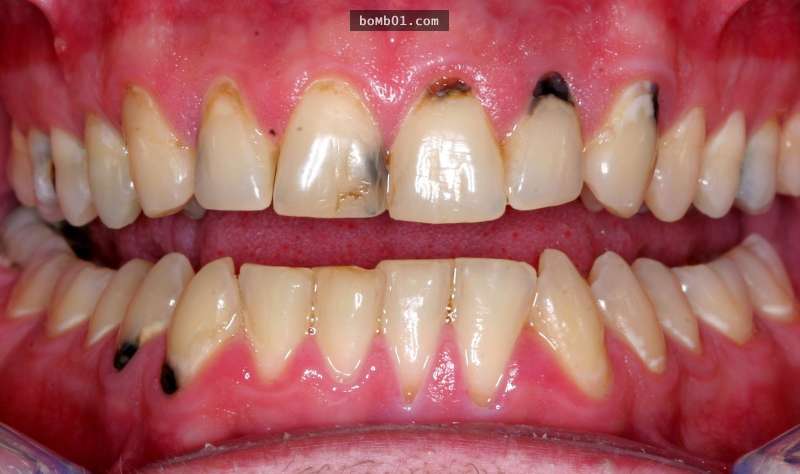 医生检看了满口烂牙的3岁小孩口腔后摇了摇头,接著